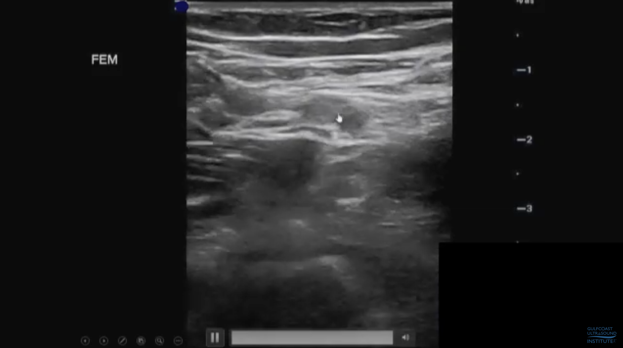 How Focused Venous Ultrasound is helping Clinicians with the Diagnosis of Lower Extremity Deep Venous Thrombosis